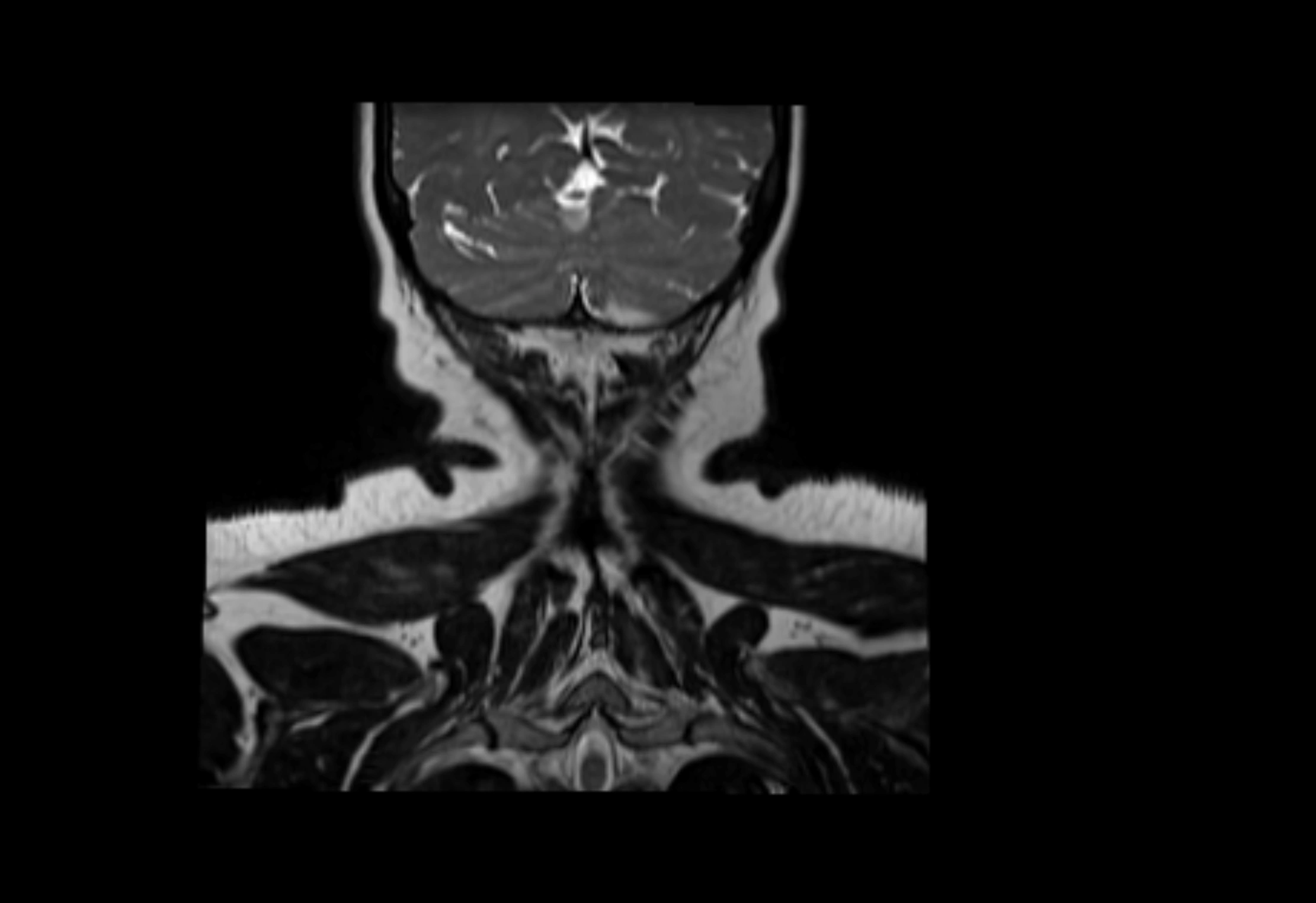 Neck coronal lymph node cross sectional MRI anatomy 3T MRI  image-img-00001-00007.webp